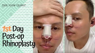 Rhinoplasty In the Philippines 1st Day Post Opp [upl. by Durr]