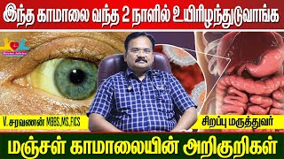 மஞ்சள் காமாலையின் அறிகுறிகள்  Jaundice Symptoms and Cure Manjal Kamalai  Hepatitis Type ABCDE [upl. by Grodin360]