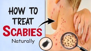 How to Treat Scabies Naturally  Home Remedies for Scabies Treatment [upl. by Irrehc]