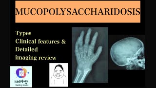 MUCOPOLYSACCHARIDOSIS Case discussion of types clinicoradiological features Morquios amp Hurlers [upl. by Durwin968]