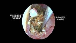 Cleaning a large amount of earwax that severely blocks the ear canal earwaxremoval earwax cleaning [upl. by Ynes]