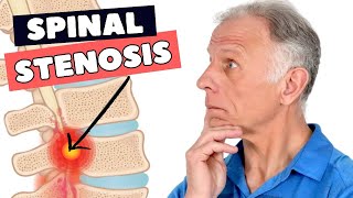 8 Fixes That Can Greatly Help Lumbar Spinal Stenosis [upl. by Wenonah]