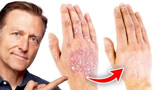 The 1 Best Remedy for Eczema [upl. by Garey204]