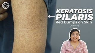 Keratosis Pilaris  Chicken Skin  How to treat Keratosis Pilaris Hindi  Dr Nivedita Dadu [upl. by Mcbride469]