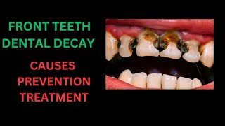 TEETH DECAY IN FRONT TEETH  EVIDENCE BASED DENTAL DECAY MANAGEMENT IN FRONT TEETH [upl. by Alburga]