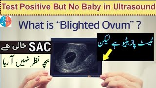 Pregnancy Test Positive But No Baby in Ultrasound  No HeartBeat at 6Weeks  Empty Sac UrduHindi 🌐 [upl. by Akimet]