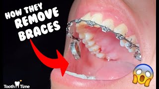 How they remove braces  Dental Braces Tooth Time Family Dentistry New Braunfels [upl. by Skier]