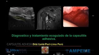 Como diagnosticar capsulitis adhesiva en ultrasonido y como realizar tratamiento ecoguiado [upl. by Mauralia]