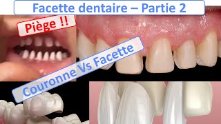 Facette dentaire  Facette Vs Couronnes Piège à éviter  Guide complet  partie 2 [upl. by Ecidnac441]