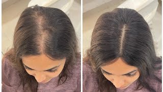 Crown Topper  Hair Patches  Top Cover Up Real Human Hair Extensions3 [upl. by Aleina]