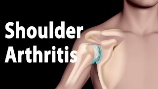 Shoulder Arthritis Narrated Animation [upl. by Katushka]