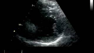 ACUTE CORONARY SYNDROME  HYPOKINESIA [upl. by Kenimod]