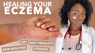 How to Treat ECZEMAAtopic Dermatitis Black Dark Skin Dry Flaky Skincare Routine Hyperpigmentation [upl. by Cariotta308]