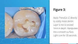 BISCO Dental Products  TheraCal LC [upl. by Eirak]