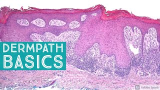 Basic Dermpath Cases  Explained by a Dermatopathologist [upl. by Austin]