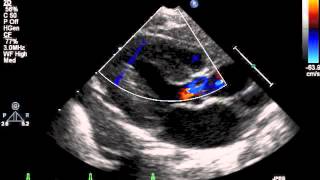 How to do pediatric echocardiography study [upl. by Natsyrt]