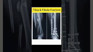 Tibia amp Fibula after surgery [upl. by Aihseyn]