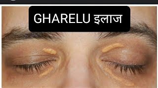 आंखों के पास पीले चकते का घरेलू इलाज  how to self treat XANTHELASMA [upl. by Hedvig]