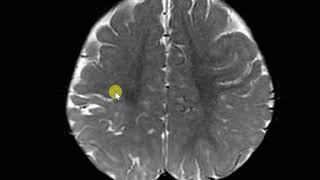 Perinatal hypoxic injuty with white matter paucity and gliosis Ulegyria [upl. by Ellehcram429]