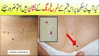 Do You Have These Red Spots On Your Skin  Anam Home Remedy [upl. by Ellegna]