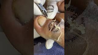 Ingrown Toenail Removal  Toenail Cutting Ep78  Xuyen Camau nailart nail nail2021 nail2023 [upl. by Yasnil]