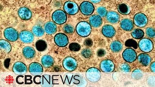 Canadian scientists help uncover sexually transmitted cases of deadlier mpox strain [upl. by Eeryt]