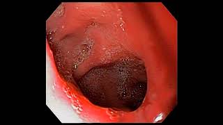 Duodenal ulcer with gastritis and reflux oesophagitis [upl. by Ennaisoj]