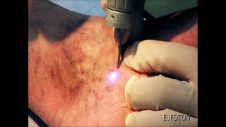 LASEmaR® 800  Transdermal Laser for Spider Veins  Laser Transdermico Teleangectasie Eufoton® [upl. by Orlosky]