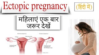 Ectopic pregnancy ectopic pregnancy sign and symptoms [upl. by Roosnam232]