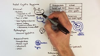 Fetal Cystic Hygroma [upl. by Nosliw]