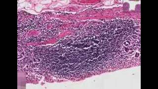 Histopathology StomachChronic gastritis [upl. by Dina]