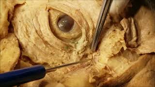 Palpebral and Lacrimal Apparatus Dissection – Clinical Demonstration – Sanjoy Sanyal [upl. by Amikehs]