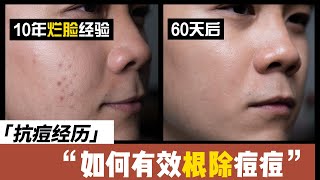 如何彻底治疗痘痘，告别痘印痘疤？【药剂师抗痘经验分享】【烟酰胺】 [upl. by Rouvin]