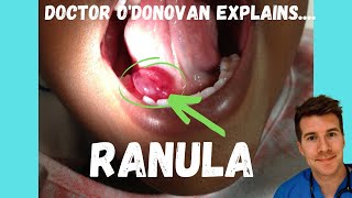 Explaining a Ranula or Mucocele  With Dr ODonovan [upl. by Sacttler92]