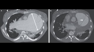 Pulmonalarterienaneurysma mit akuter Dissektion [upl. by Roeser]