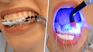 BRACES REMOVAL PROCESS  Satisfying [upl. by Aubrie]