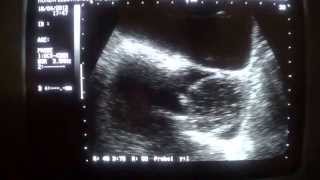 COMPLICARED OVARIAN CYST post hysterectomy [upl. by Edithe770]