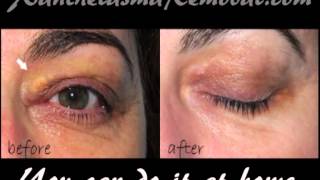 Xanthelasma removal at home [upl. by Ranna]