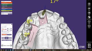 exocad  Rattrapage daxe [upl. by Danica]