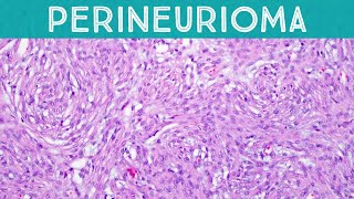 Perineurioma swirling whorling benign amp beautiful soft tissue tumor [upl. by Allertse]