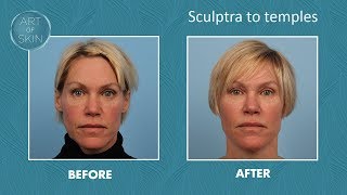 Sculptra injection to temples [upl. by Figge]