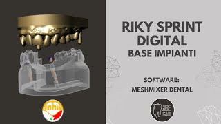 MESHMIXER DENTAL INHIO RIKY SPRINT DIGITAL BASE IMPIANTI NEW ANCORVIS INTRAORAL SCAN EXOCAD 3SHAPE [upl. by Rollecnahc602]