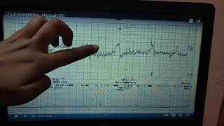 CARDIOTOCOGRAM interpretation in easy way must do for OSPE [upl. by Dayle]