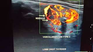 Échodoppler thyroïdien Nodule TIRADS 4c [upl. by Nitsirt]