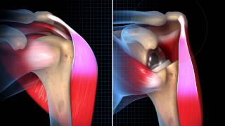 Biomechanical Summary of Reverse Shoulder Arthroplasty [upl. by Martinic337]