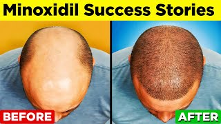 MINOXIDIL  A StepbyStep Guide to Regain Your Hair [upl. by Sedgewinn473]