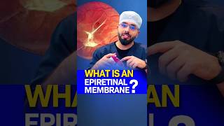 What is an EPIRETINAL MEMBRANE [upl. by Maillliw]