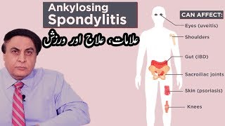 Ankylosing Spondylitis Disease  Symptoms Causes Diagnosis amp Treatment by Dr Khalid Jamil [upl. by Prudy]