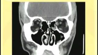 Ophthalmology Lecture  Eye Anatomy Part 3 [upl. by Yusem]