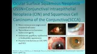 Ocular Surface Squamous Neoplasia  Presenter Carol L Karp MD [upl. by Wescott]